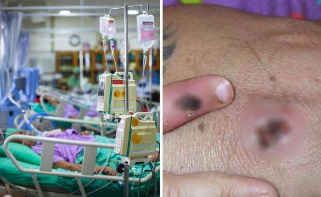 אבעבועות הקוף